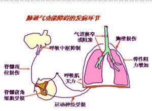 肺性脑病