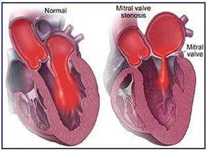 风湿性二尖瓣狭窄