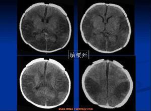 短暂性大脑缺血性发作