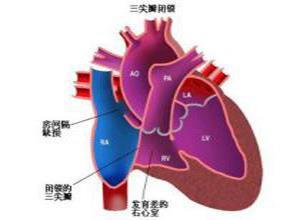 二尖瓣闭锁不全