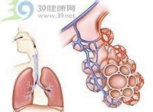 二氧化硫中毒