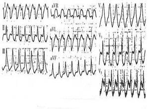 房室折返性心动过速