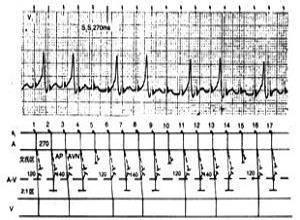 房性心动过速伴房室传导阻滞