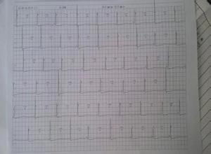 房性逸搏和房性逸搏心律