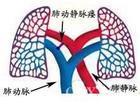 肺动静脉瘘