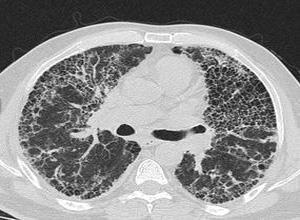 肺囊性纤维化