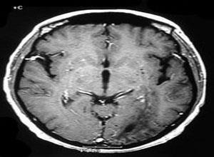 副肿瘤性斜视性眼肌阵挛-肌阵挛