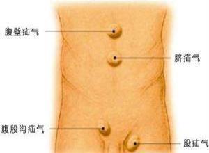 腹股沟滑动疝