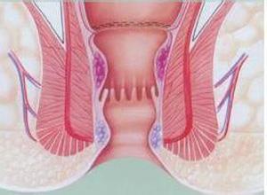 肛管内括约肌痉挛性收缩