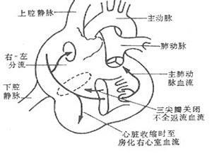 三尖瓣下移畸形