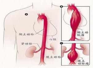 胸降主动脉动脉瘤