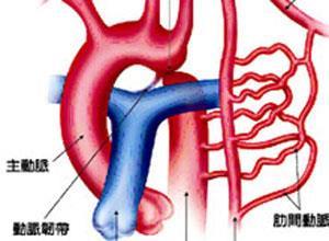 先天性主动脉缩窄