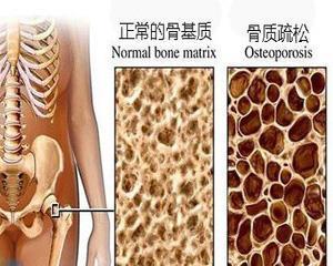 绝经后骨质疏松