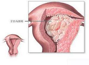 绝经后子宫内膜癌