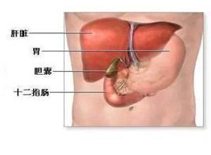 克里格勒-纳贾尔综合征