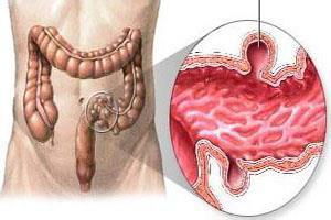老年人结肠憩室