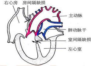 心室间隔缺损