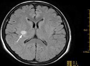 老年人腔隙性脑梗死