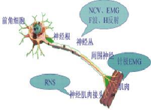 老年人运动神经元病