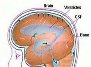良性颅内高压症