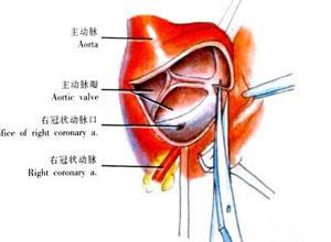 主动脉瓣关闭不全