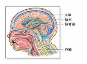 颅内静脉窦闭塞性颅高压