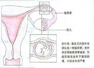 卵巢妊娠