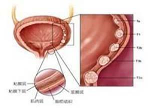 泌尿道肿瘤