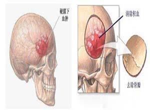 脑外伤后综合征