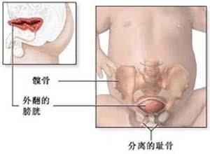 膀胱不发育与发育不全