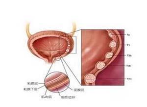 膀胱肿瘤