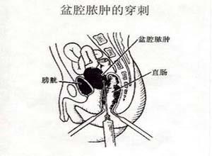 盆腔脓肿