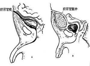 脐尿管囊肿