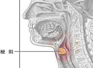 气管梗阻