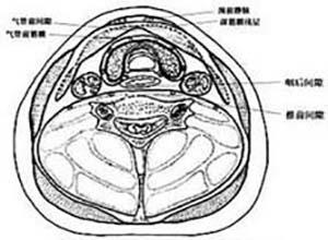 气管前间隙感染