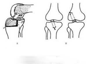 前十字韧带损伤