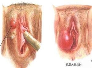 前庭大腺囊肿