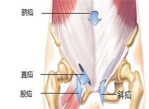 嵌顿性腹股沟斜疝