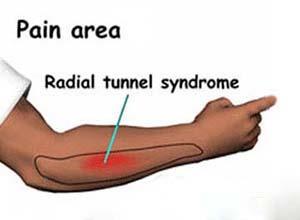 桡管综合征