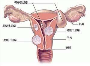 妊娠合并子宫肌瘤