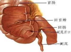 妊娠性急性阑尾炎