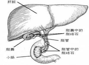 胆石性肠绞塞综合征