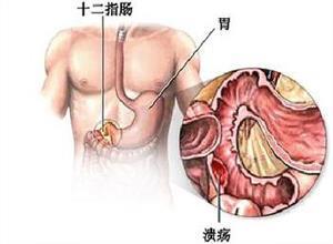 十二指肠溃疡
