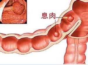 多发性消化道息肉综合征