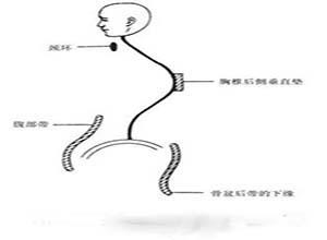 舒尔曼病