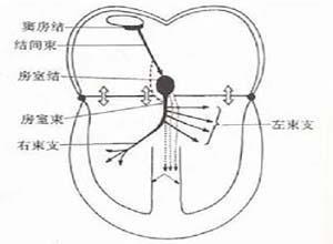 双侧束支传导阻滞