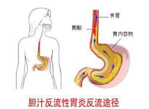 胆汁返流性胃炎