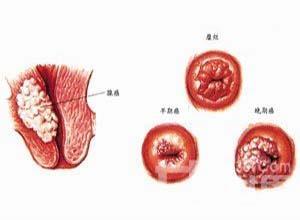 微囊肿腺癌