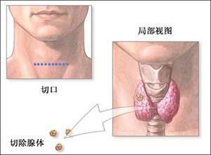 无功能性甲状旁腺囊肿