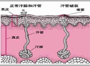 下丘脑多汗症